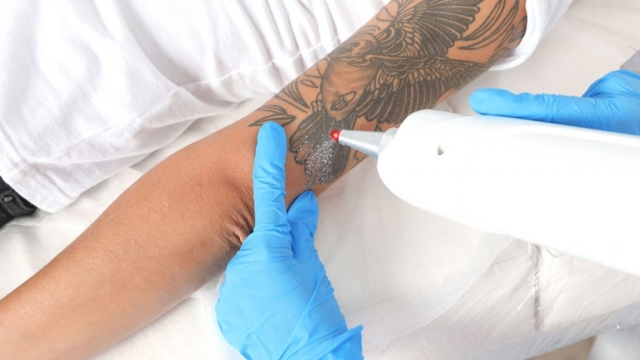 Is Ipl Tattoo Removal Right With Regard To You?