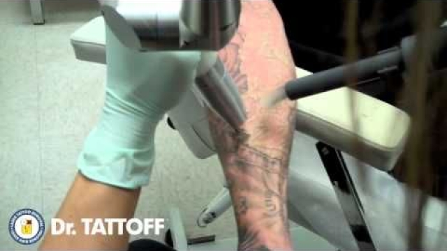 Removal Of Tattoo By Surgery, By Laser, Or By Emulsion?