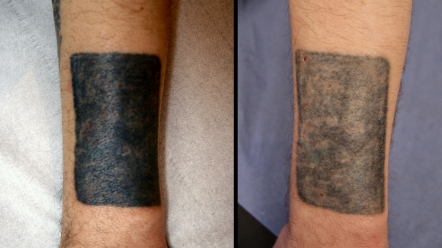 What Is Involved With Tattoo Removals?