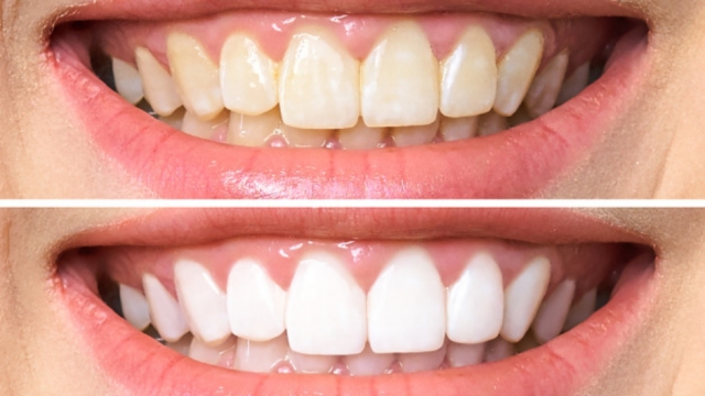 Light Up Your Smile: The Top Teeth Whitening Products for a Dazzling Transformation