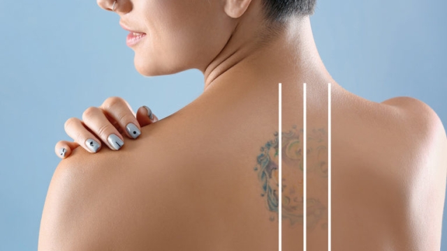 Tattoo Laser Removal –  3 Reasons Why Your Tattoo May Need To Go!