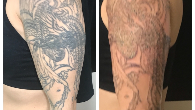 Tattoo Removal Options – Laser Tat Removal Possibly A Tattoo Removal Cream