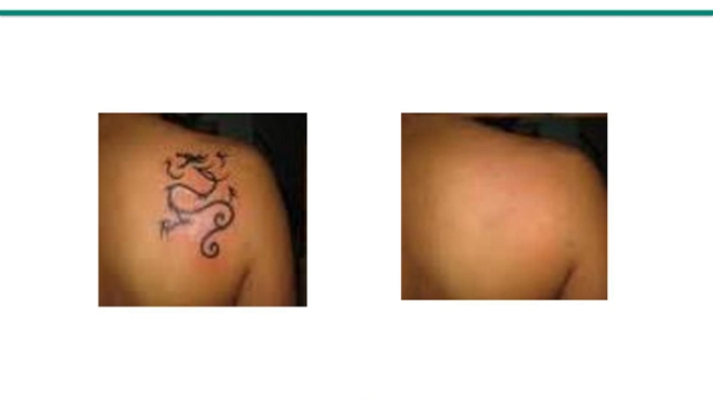 The Tattoo Laser Treatment – How Well Does It Work?