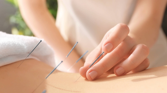 The Healing Power of Acupuncture: Needle Your Way to Wellness